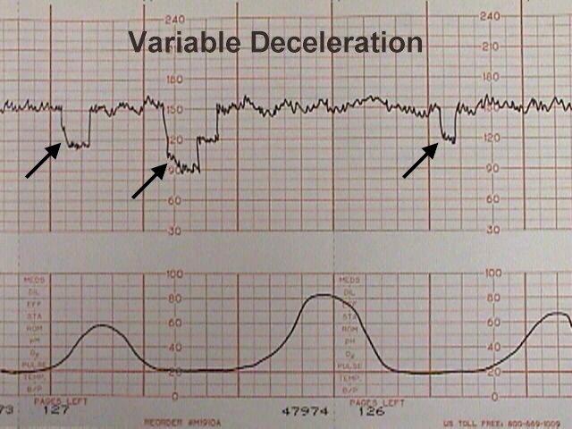 electronic-fetal-heart-monitoring